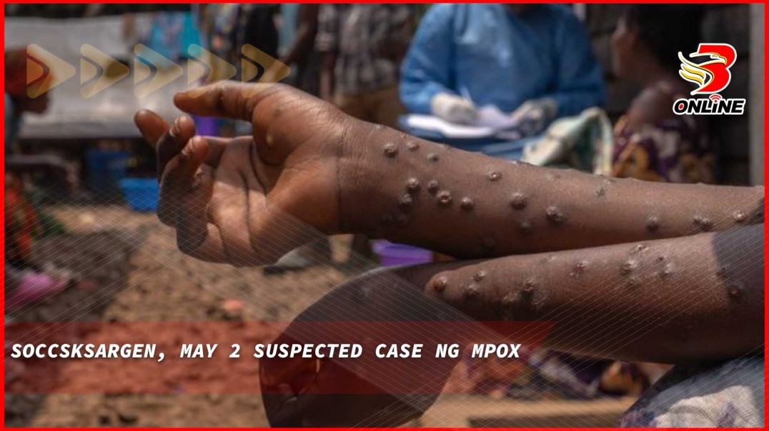 SOCCSKSARGEN, may 2 suspected case ng mpox